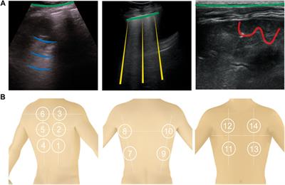Sonographic Diagnosis of COVID-19: A Review of Image Processing for Lung Ultrasound